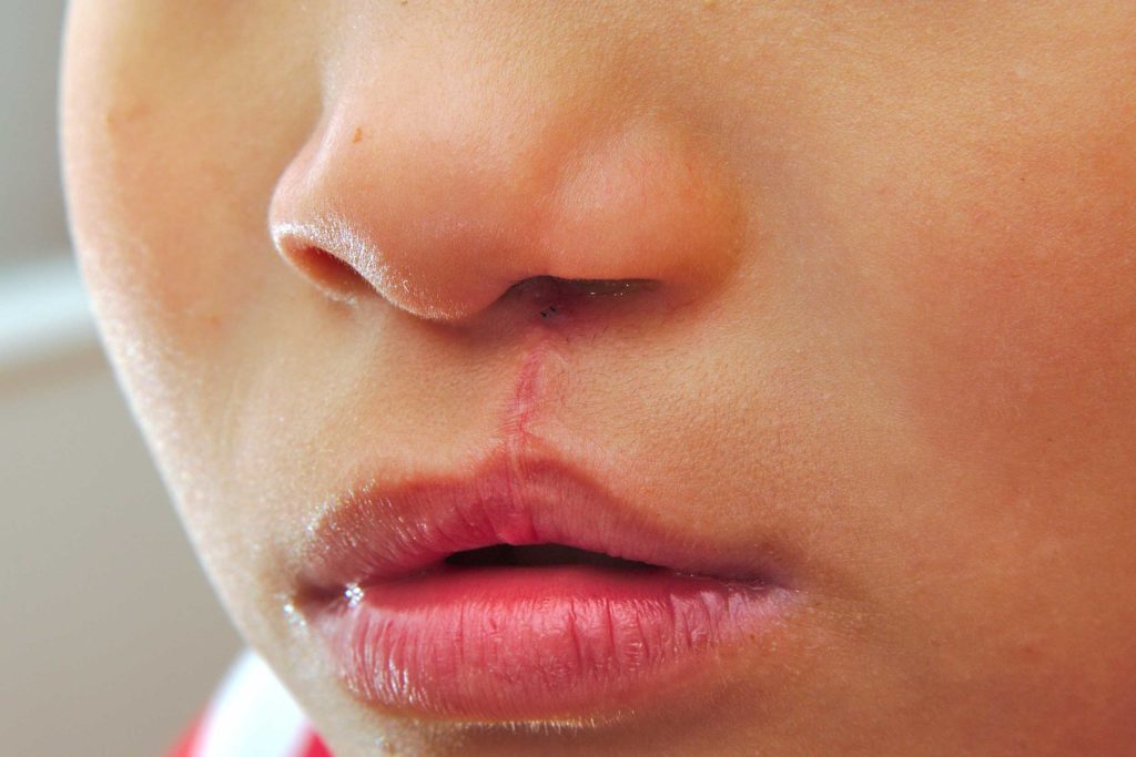 Cleft Lip & Palate Surgery