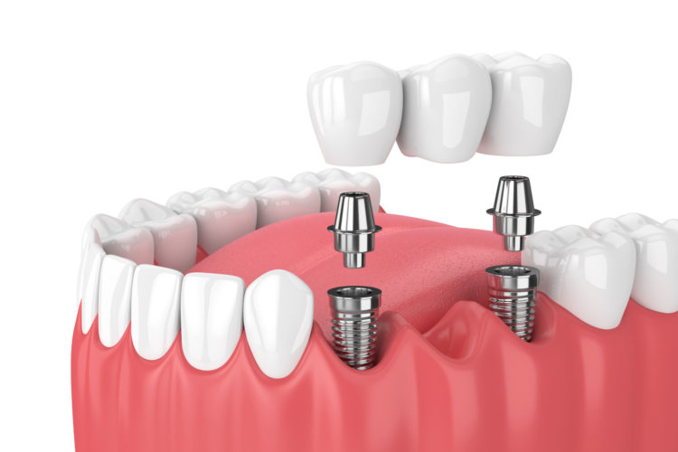 fixed_bridge_dental_implant_in_roanoke