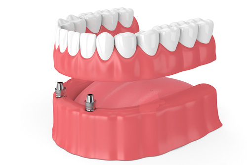 removable overdenture