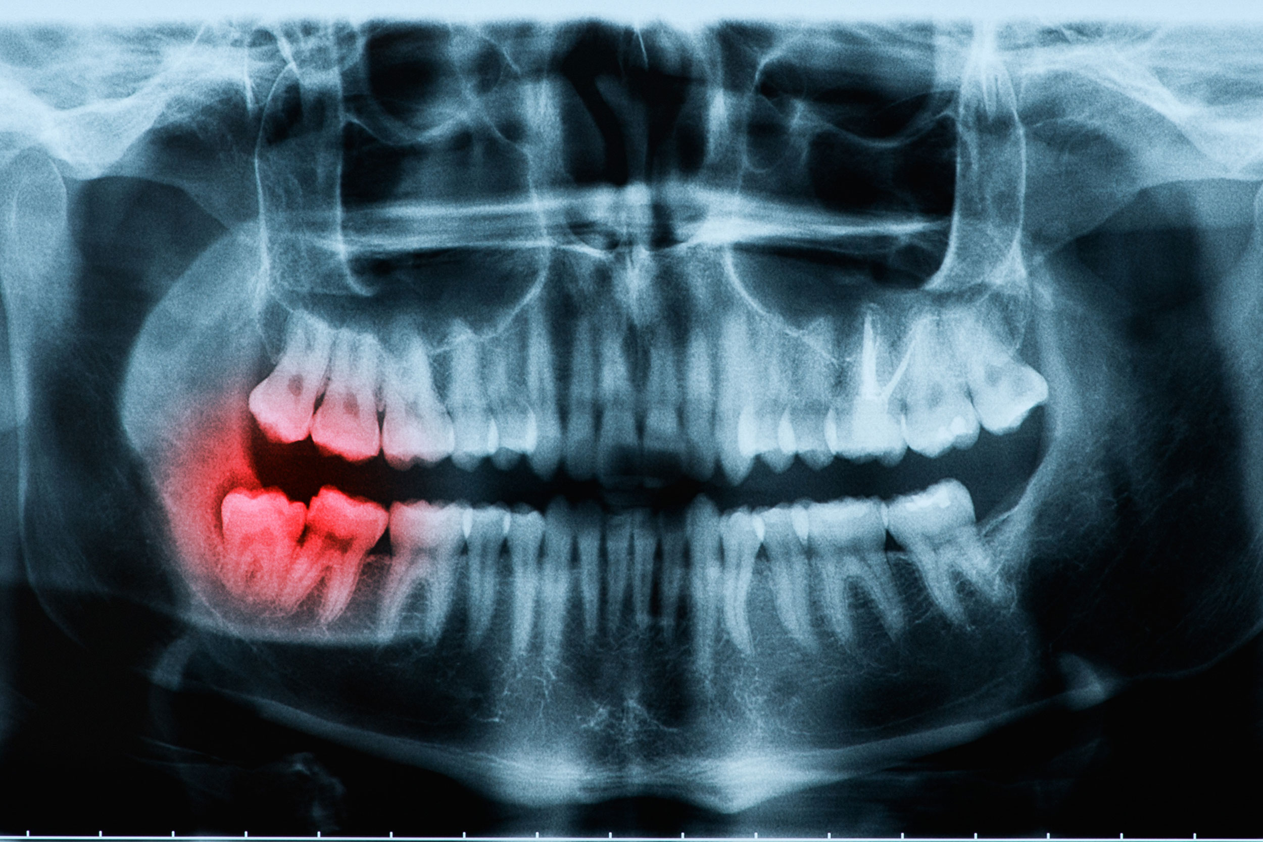 The 10-Second Trick For Wisdom Teeth Xray