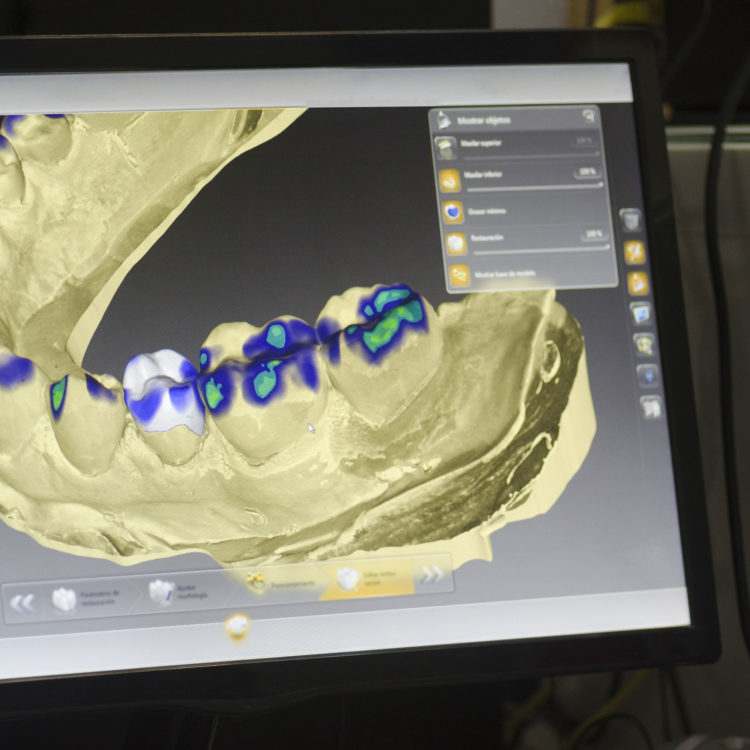 intraoral scanning dental implants